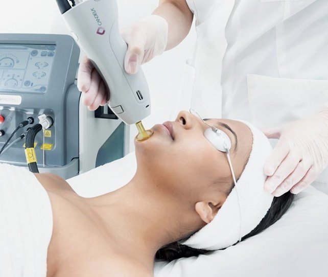 Facial Laser Hair Removal