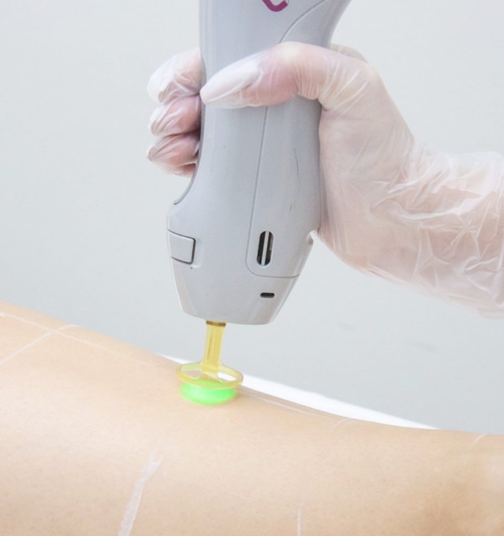 Bikini Laser Hair Removal