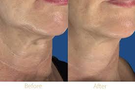 Neck RF Microneedling