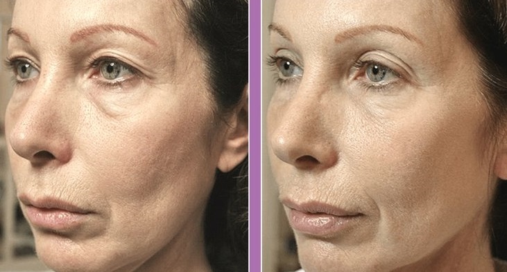 Full Face Thermage FLX