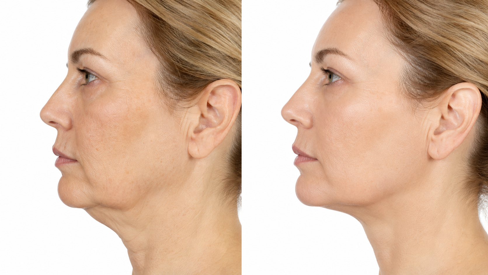 Before and after: skin laxity and jawline