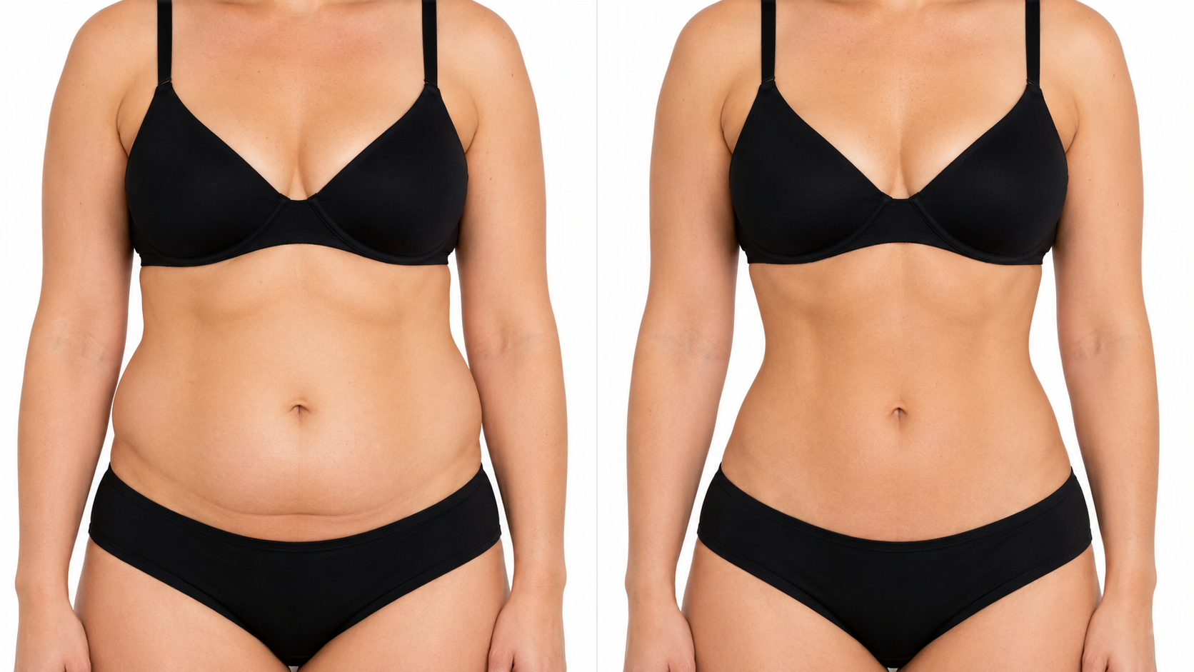Before and after: body contouring abdomen