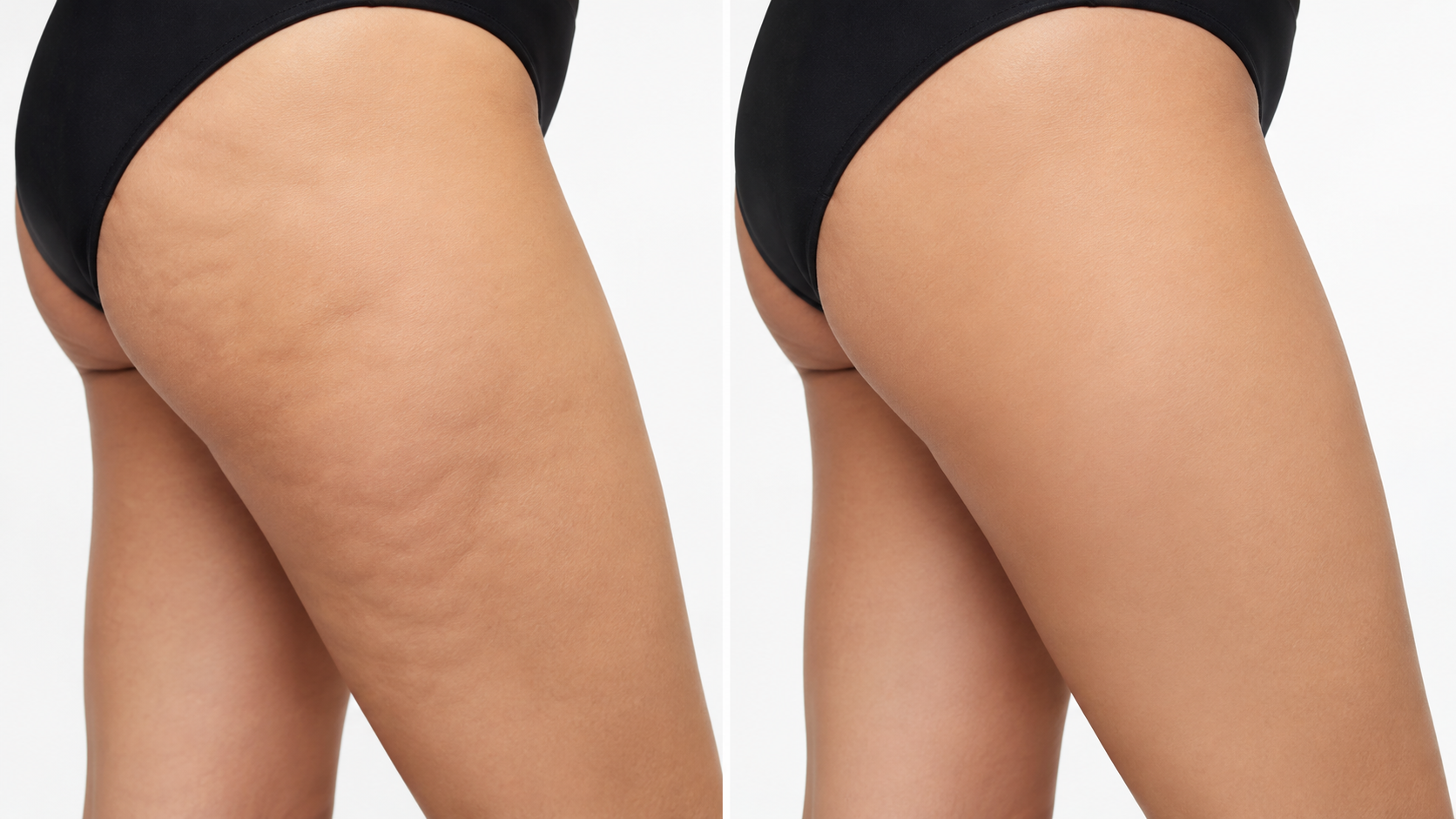 Before and after: cellulite on thighs