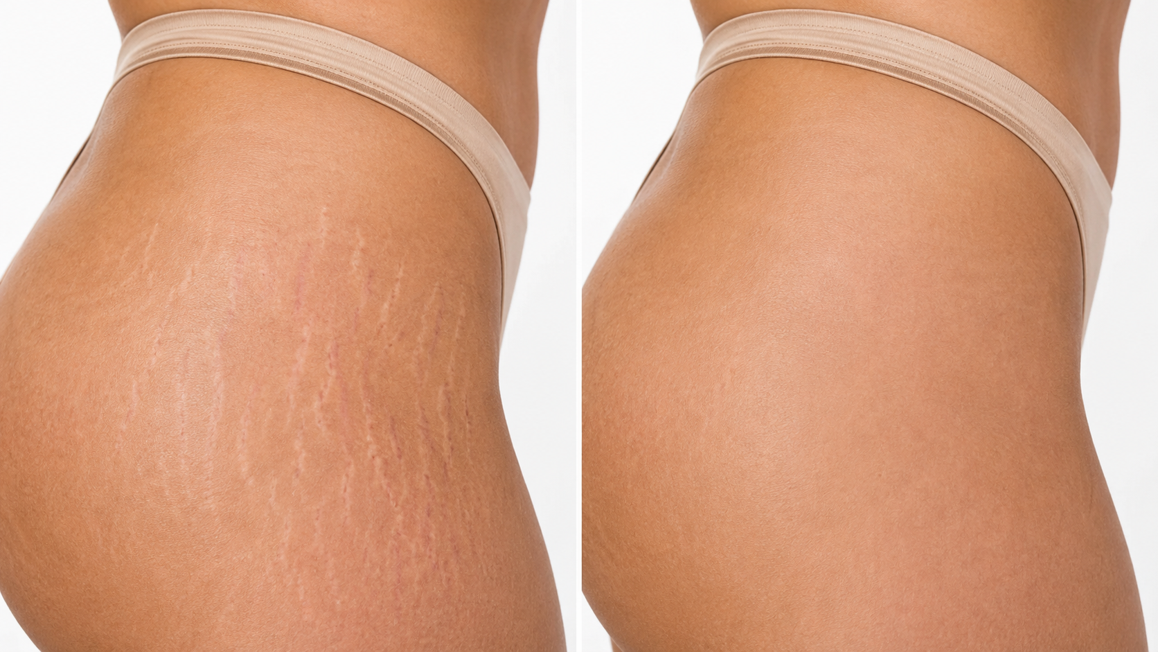 Before and after: stretch marks